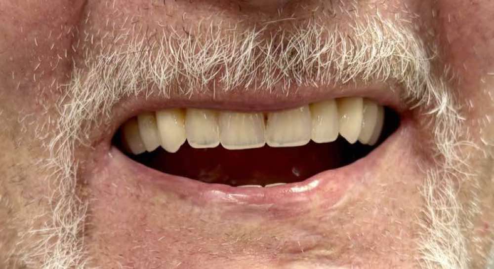 Full Dentures