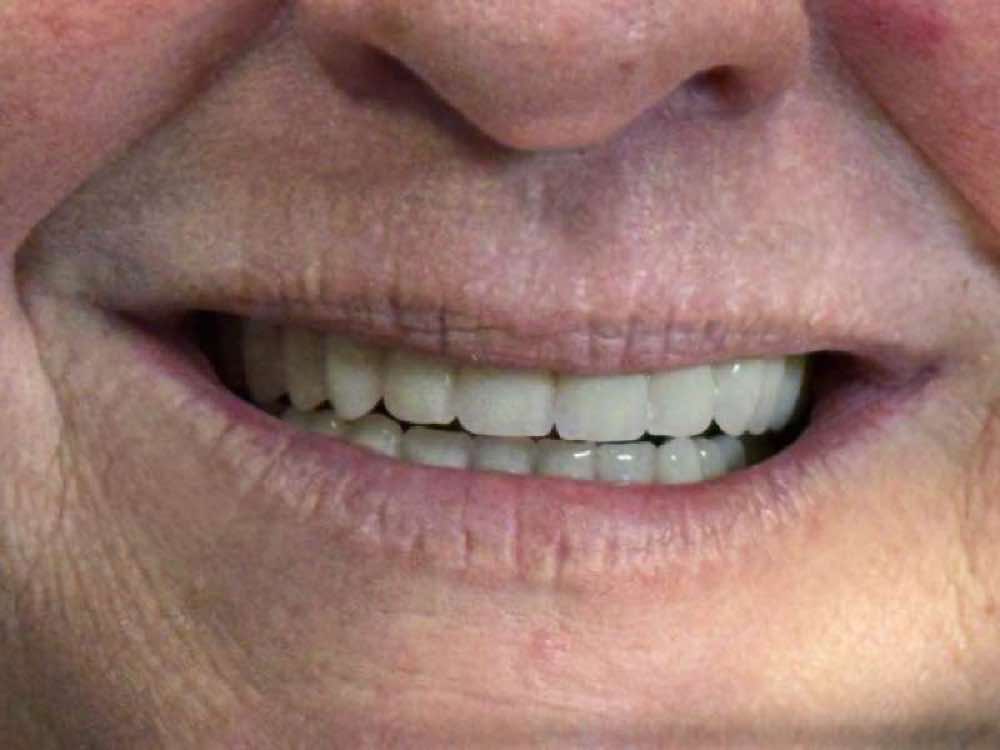 Restored smile