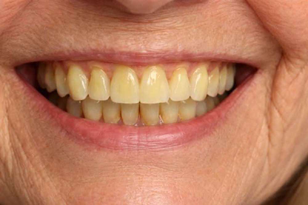 Emergency Denture Repairs