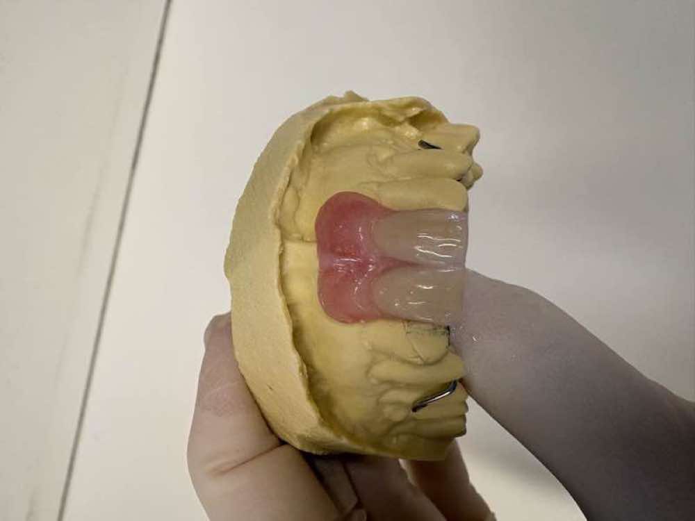 Partial Dentures