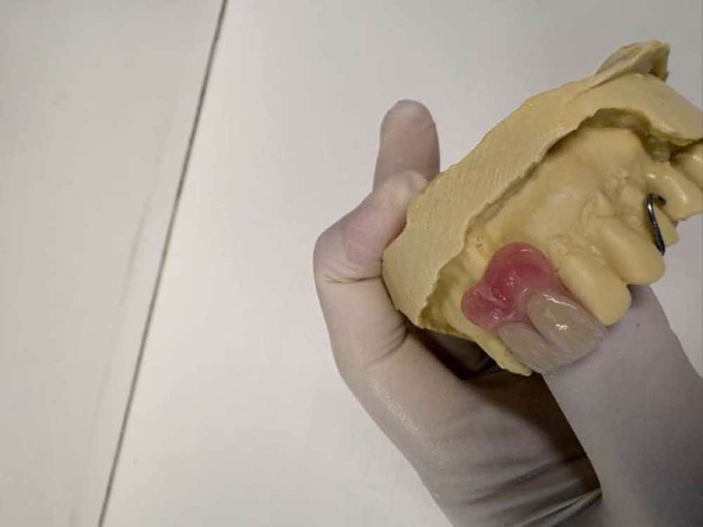 Custom denture samples